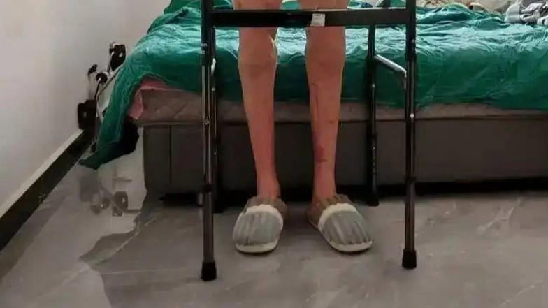 男子双腿被绞断 20个月后恢复行走热搜配图